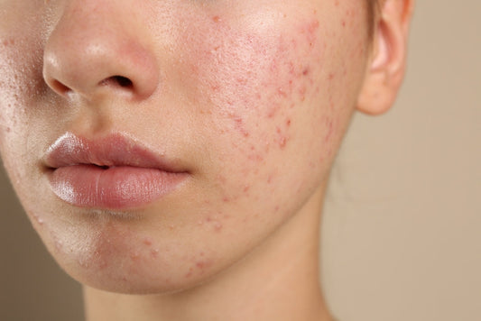 Acne Explained: Causes, Treatment & The Best Skincare Routine for Clear Skin